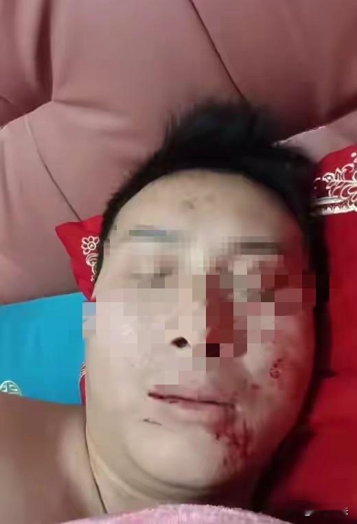 四川达州，一男子结婚当天，想和妻子发生关系，谁知他刚想上去，就被妻子抓伤脸部，男