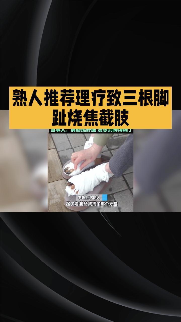 熟人推荐的“家中理疗”竟致三根脚趾烧焦截肢，责任该谁承担？近日，河南54岁的李