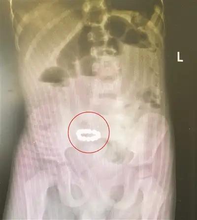 “菊花”失守72小时：一根网红“快乐棒”如何捅穿整条防线？1️⃣急诊室凌