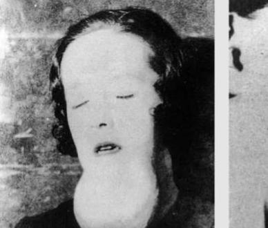 1922年，有一名25岁的少女因为牙疼去看病当医生轻轻的触碰牙齿时，她的下颚骨却