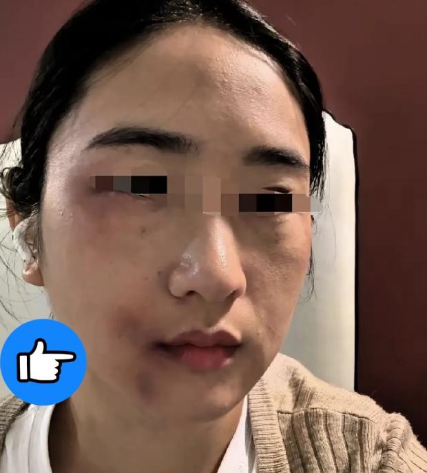 昨天被丈夫打了。我弟弟知道以后，从家里拿了根钢管赶来我家。丈夫打开门，弟弟没说话