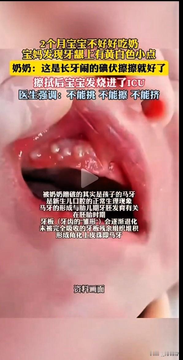 西安两个月宝宝进ICU，只因奶奶“好心”办了坏事！宝宝牙龈上的“小白点”千万别乱