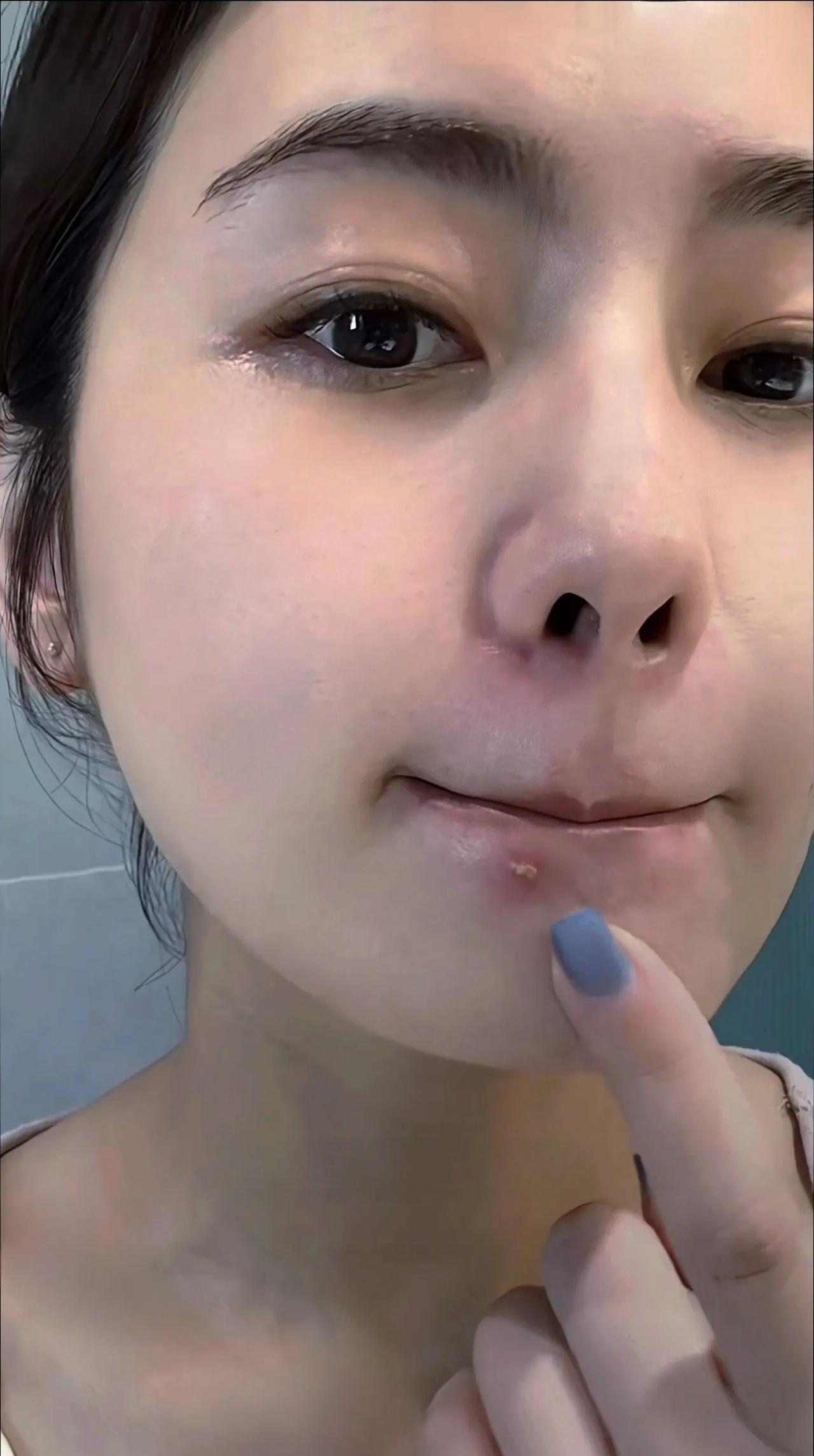 快点结婚吧！结婚了你的痘痘就好了！这是我长痘后听到的最多的一句话！难道男人对