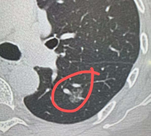4mm磨玻璃结节，术后确诊肺微浸润癌？不少朋友查出几毫米的肺磨玻璃结节，还听说可