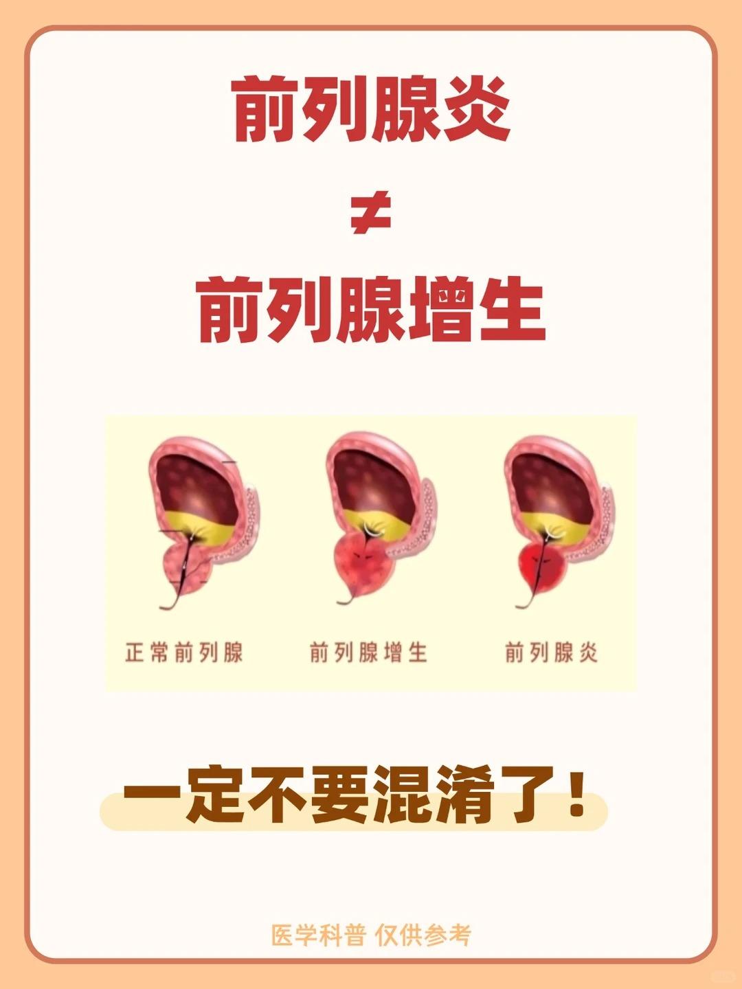 前列腺增生不是前列腺炎，一定不要混淆了