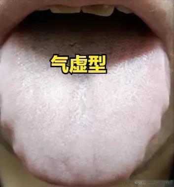 气虚型“有心无力”：补元气、固根本，才能恢复身体底气大家好，我是陈大夫！