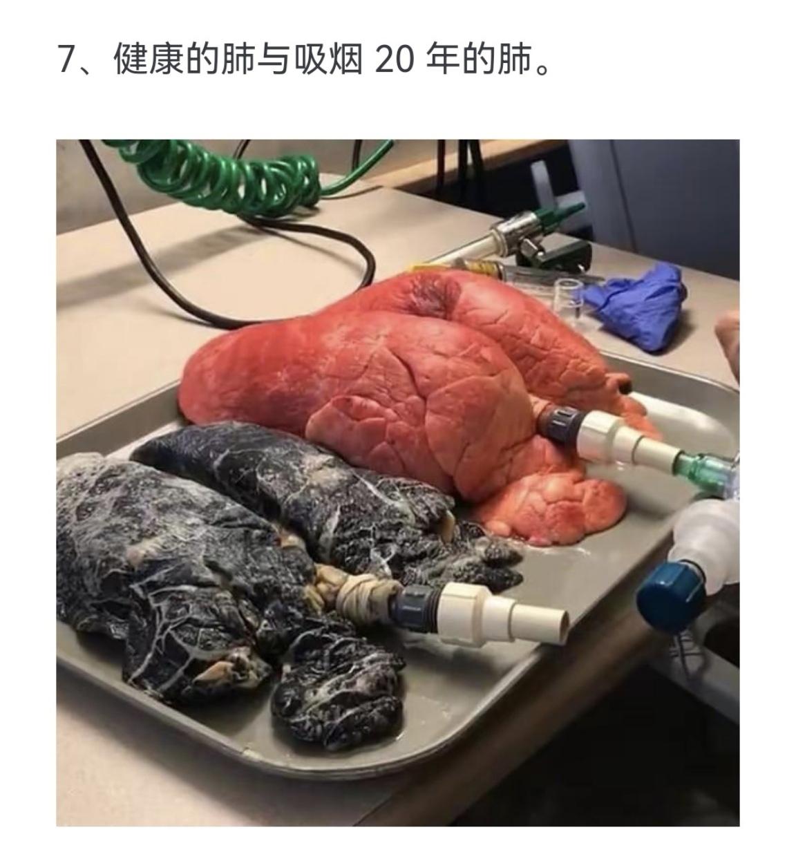 健康的肺与吸烟 20 年的肺