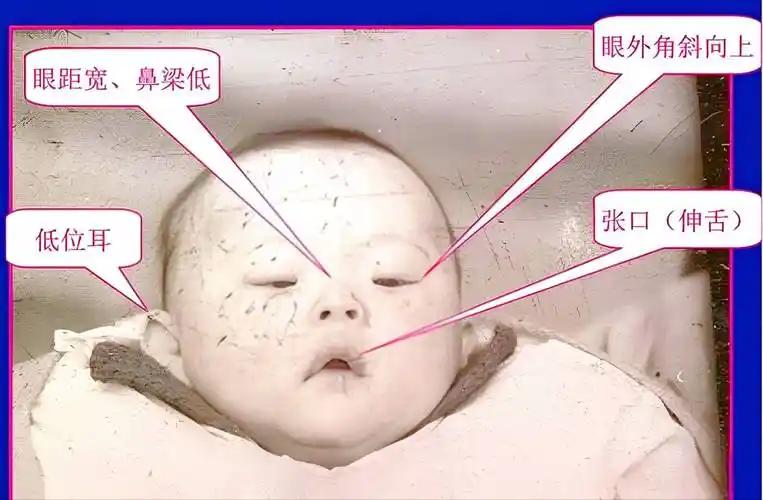 为什么全世界的唐氏儿，都长着同一张脸？翻看全世界唐氏综合征患者照片，不论黑人