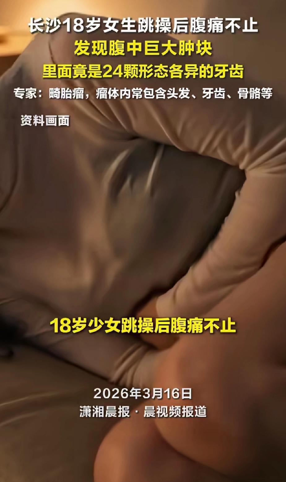 大千世界，无奇不有！女子腹痛，医生竟从肿瘤里面取出24颗不规则的牙齿，太惊人了！
