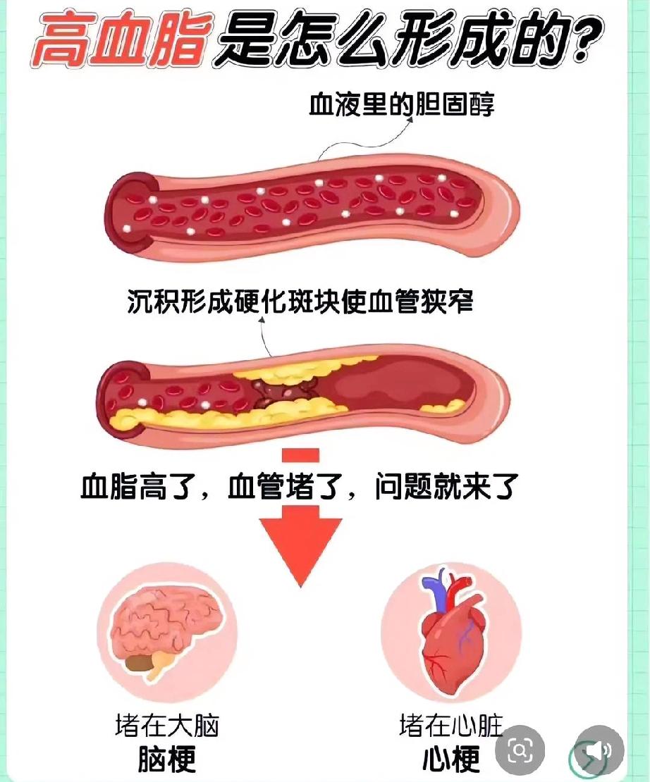 55岁的林女士突然脑梗离世，生前每天雷打不动快走六千步，晚上十点前肯定上床睡觉，