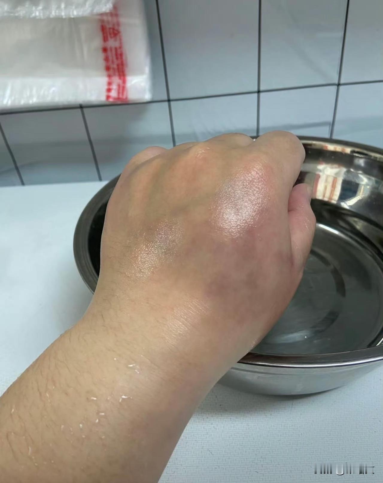 手镯戴10年没摘，竟直接“长”进肉里流脓？这事咱身边人都得注意福建宁德有个