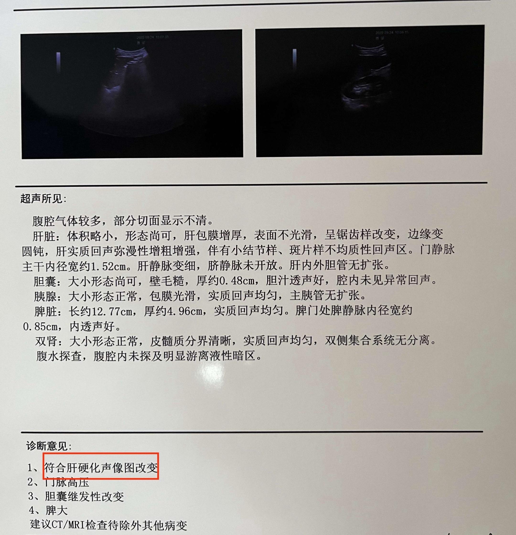 乙肝想知道有没有肝硬化，记住这4组数字！1、门静脉直径大于1.3cm...