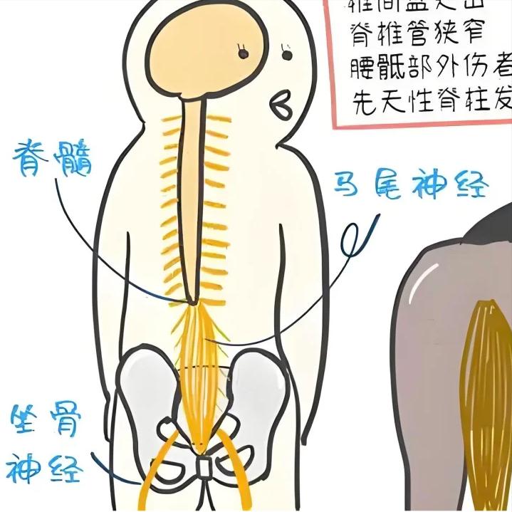马尾神经损伤，是最难以言说的痛！马尾神经损伤虽不为人熟知，但却是骨科最严重的急