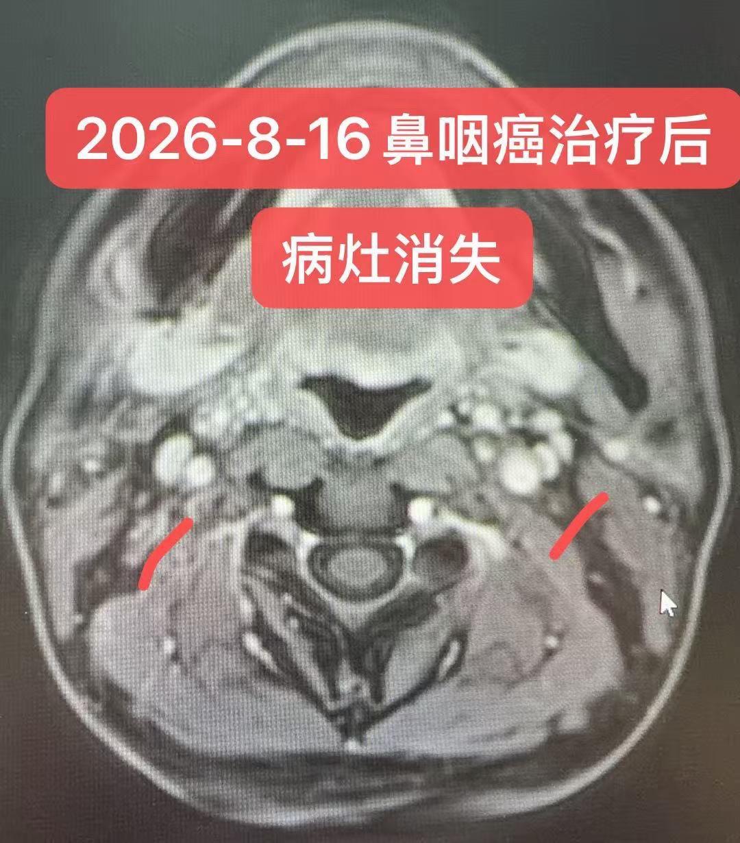 局部晚期鼻咽癌的治疗。男性，39岁。确诊为鼻咽非角化性鳞状细胞癌（未分...