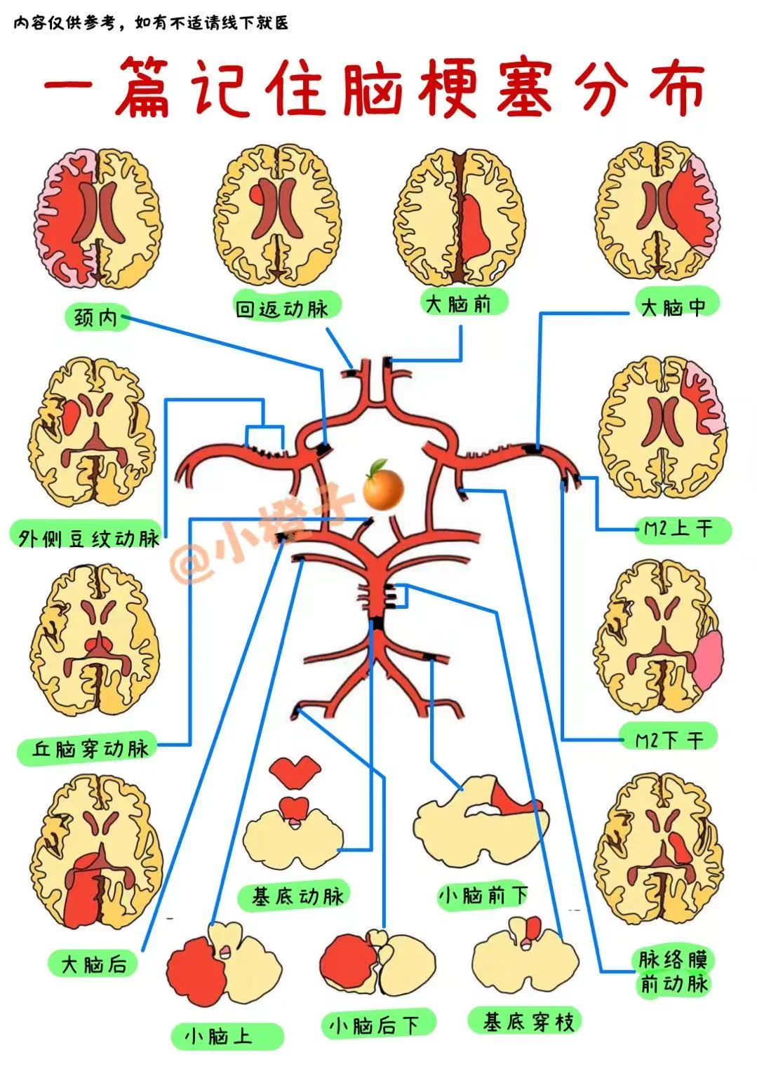 📖手绘笔记｜一篇记住脑梗定位分布及表现✅