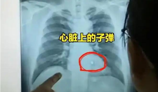 “全球首例！”1995年，湖南，符桂林胸部中枪后，医生却没有在体内找到子弹！医生