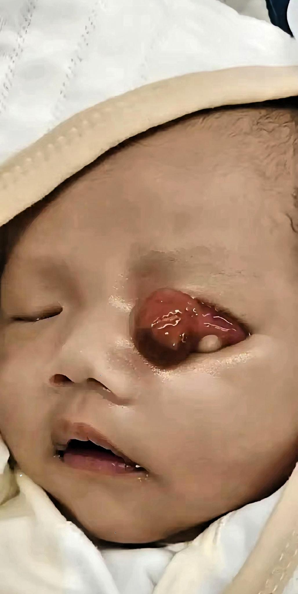 泪目！河南郑州，一家人在妇幼门口等着，娃刚落地，左眼皮上贴着一团肉，鼓鼓的把眼睛