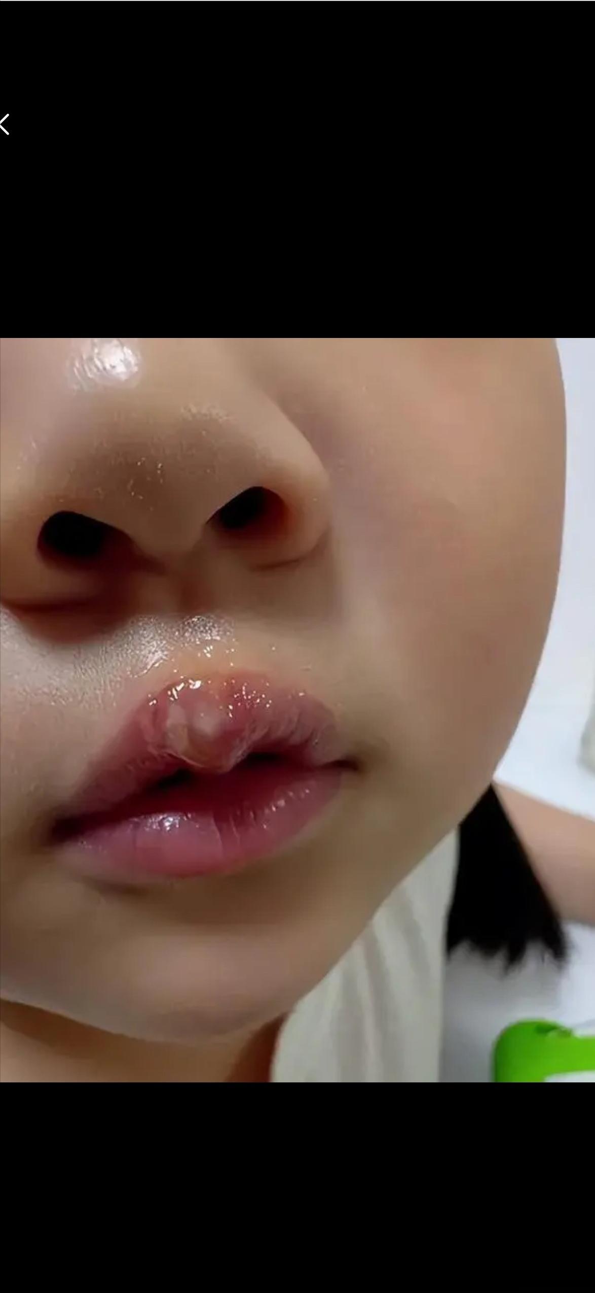 太狠心了！幼儿园4、5岁的孩子讲话，陈老师生气惩罚，用热熔枪烫坏孩子们的嘴唇、掌