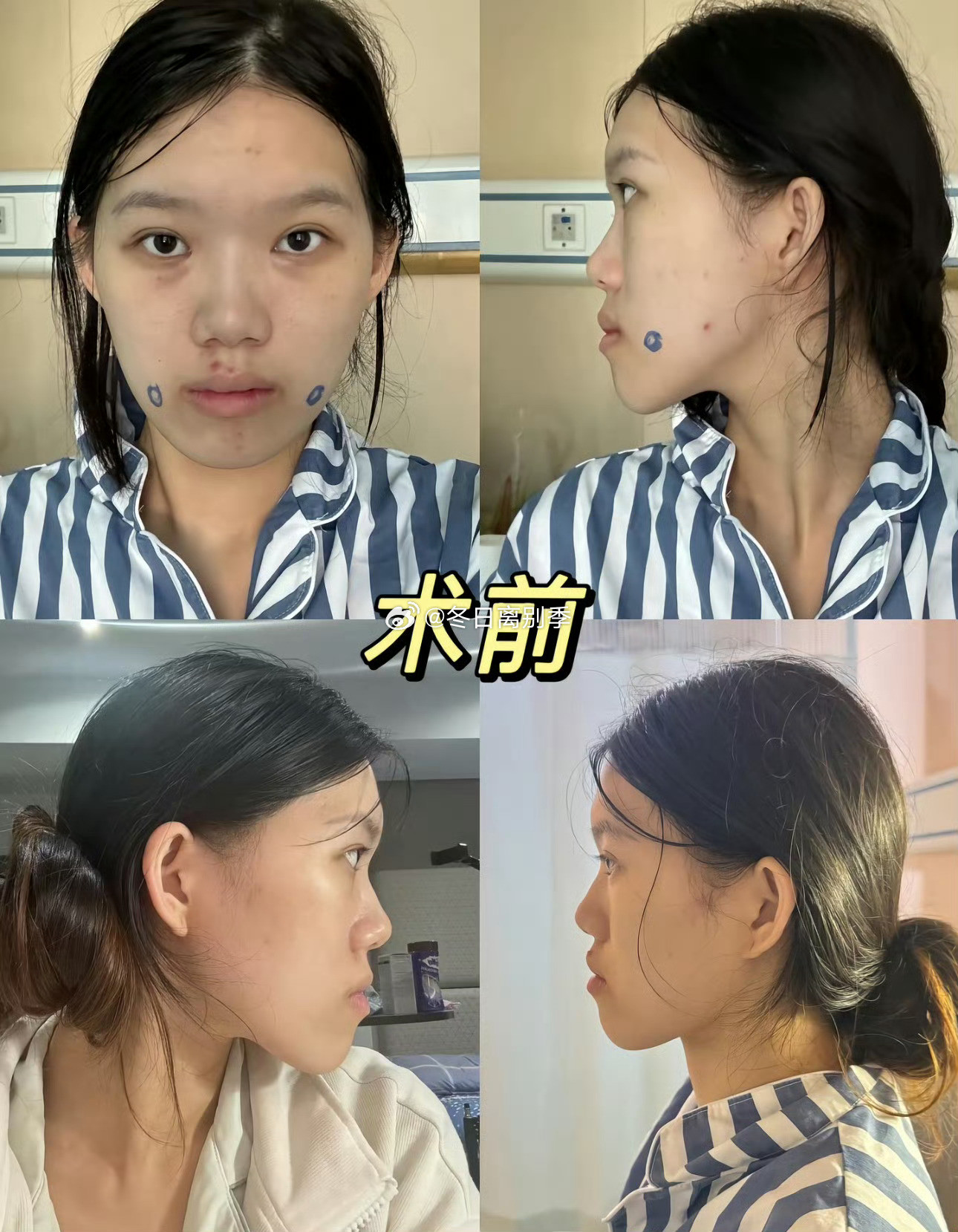 24岁女孩地包天做手术反成鞋拔子脸仅仅只有2毫米轻微地包天，本来正畸就能解决，却