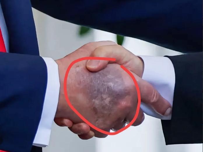 特朗普在白宫会见李在明，被记者拍到手背乌黑淤青，最初面积小时还涂遮瑕膏，现在面积
