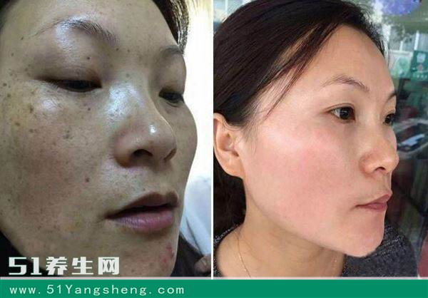 鸡蛋清加它比激光还好? 美容院专家揭晓, 快速祛斑美白肌肤