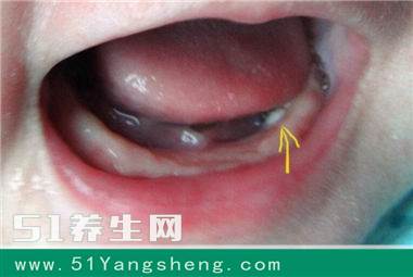 惊险, 婆婆用布蘸盐水擦宝宝口腔, 差点要孩子的命, 家长千万别犯