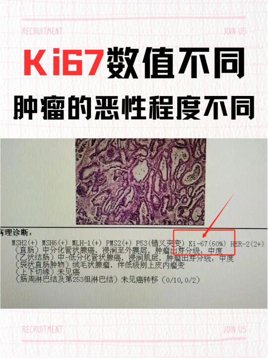 Ki67 数值与肿瘤的关系｜一篇讲透关键指标