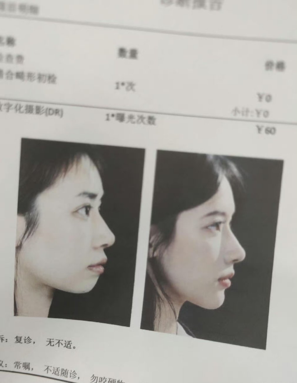 女生把牙齿整形前后对比​​​