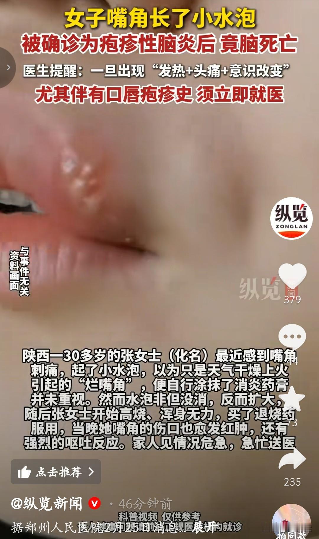 你敢相信吗？仅仅因为嘴上的小水泡，30多岁的女子被宣告脑死亡。陕西这位张女