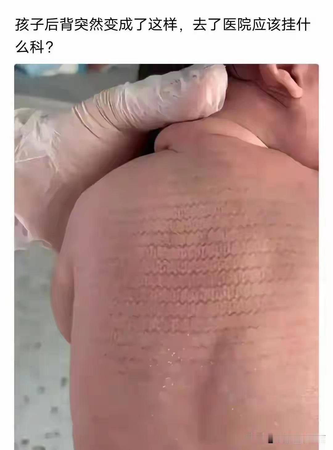 给他们父母两个大耳刮子宝宝以后就不复发了
