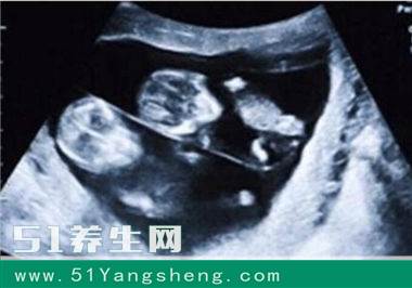 产妇顺产生下一对龙凤胎, 看到男宝宝时, 宝爸大惊: 哪吒转世