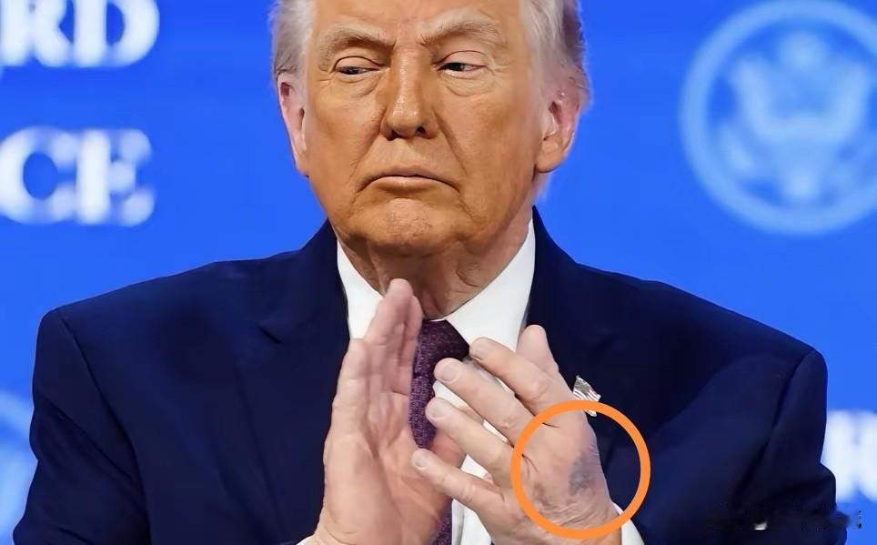 特朗普不再掩饰手背淤青！特朗普现身达沃斯，媒体更多地把关注点放在了他的演讲内容上