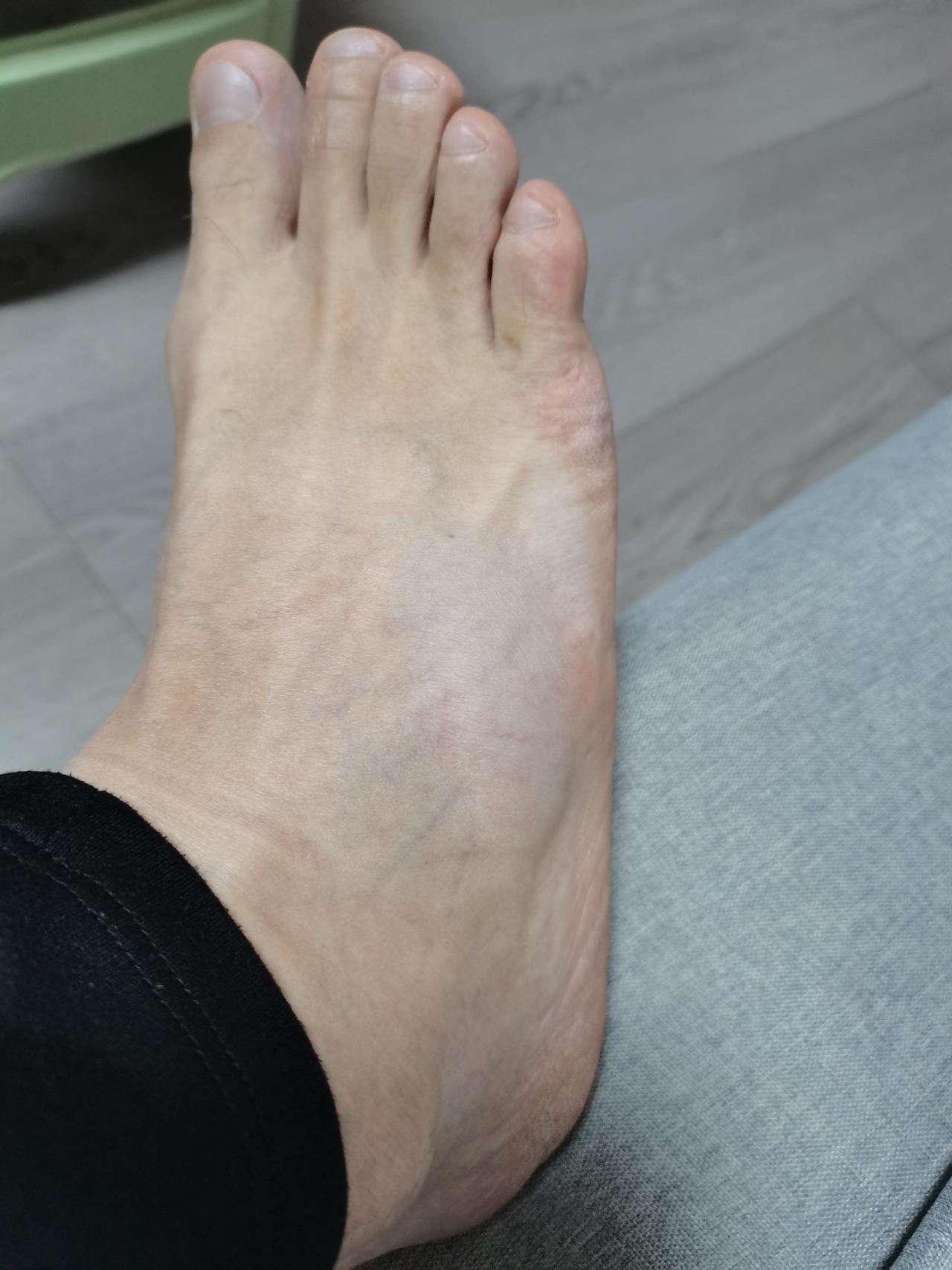 唉，恢复跑的道路总是意外重重，大半年没跑了，好不容易重新恢复跑步了，坚持了一个月