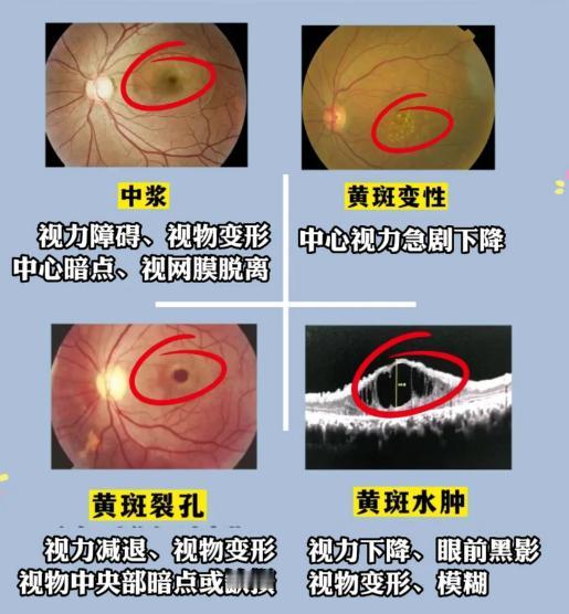 黄斑水肿反复发作？千年古方来破解困局，标本兼治，水肿都消了！在医疗领域，黄斑水