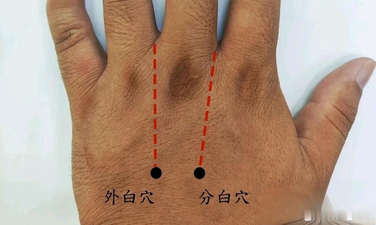 董氏奇穴应用案例:腰部直立不适案例:腰部直立不适性别:女主诉:直腰站立不能时间