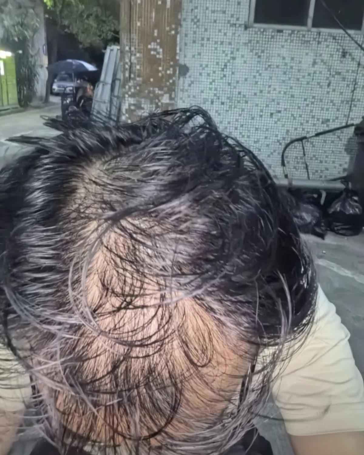 熬夜=自毁容颜！科学验证发际线危机医学机构研究发现，熬夜对发际线的危害性是真