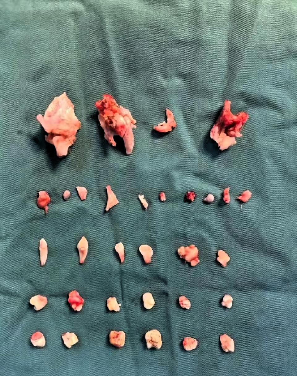 湖南长沙一位18岁女孩曾琳琳，前段时间在家跳操，跳着跳着右下腹突然开始剧烈疼痛，