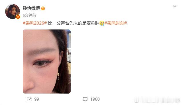 孙怡眼睛长麦粒肿孙怡浪姐累到眼睛长麦粒肿了，要照顾好自己啊。孙怡累到长麦粒肿