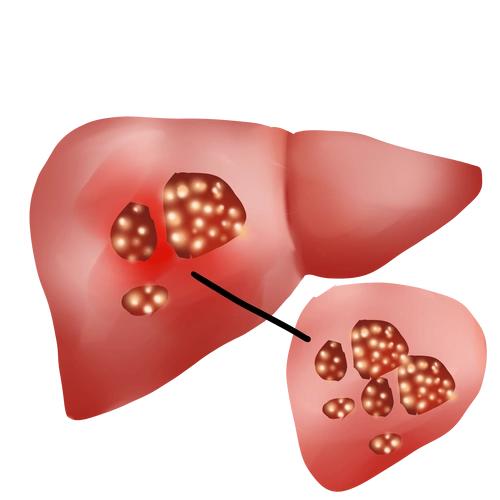 肝癌早筛，这2项检查比CT更实用！很多人白花钱还漏诊每天门诊都能遇到肝癌中晚