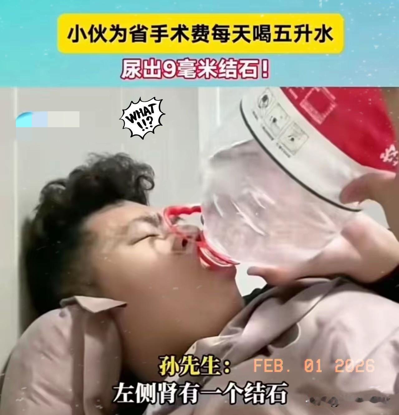 真是一个狠人啊！小伙为了省12000手术费，每天喝五升水，结果尿出9毫米结石！小