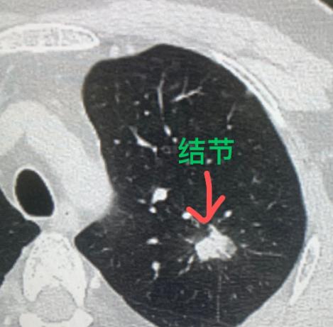 幸亏妻子拉他去了医院，才抢回一条命！肺上的问题一查出来，就已经不是早期了……