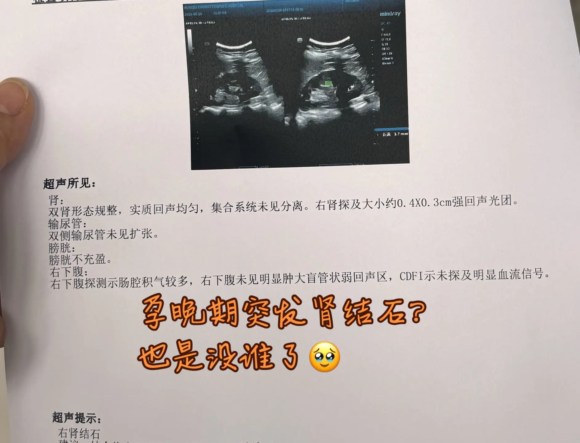 一个身体两个心跳💗💗。上午突然右下腹疼到冒冷汗，连呼吸都费劲😣 ...
