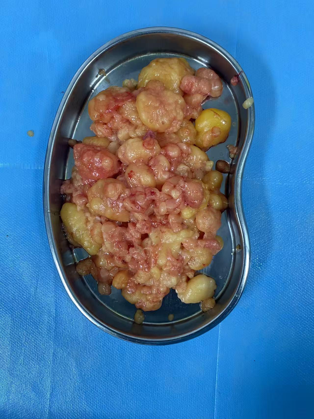 脂肪瘤能不做最好还是不做，只要不影响生活质量，没啥要紧的。我这一身脂肪瘤还是专门