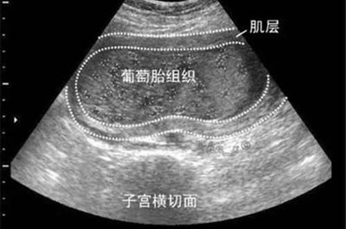 葡萄胎究竟是怎么回事? 葡萄胎的治疗方法推荐