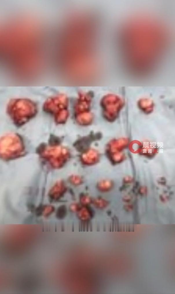 女子腹部隆起被误认怀孕6个月，手术取出50颗肌瘤，医生一句话引人深思！近期一