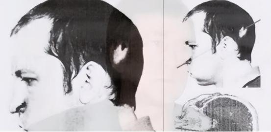 1978年，苏联一位物理学家，不小心被高辐射的粒子光速击穿脑袋。但随后却发生了奇