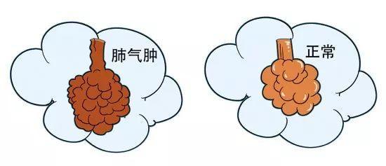 什么是慢阻肺? 哪些人容易得慢阻肺? 慢阻肺的危害、预防与治疗