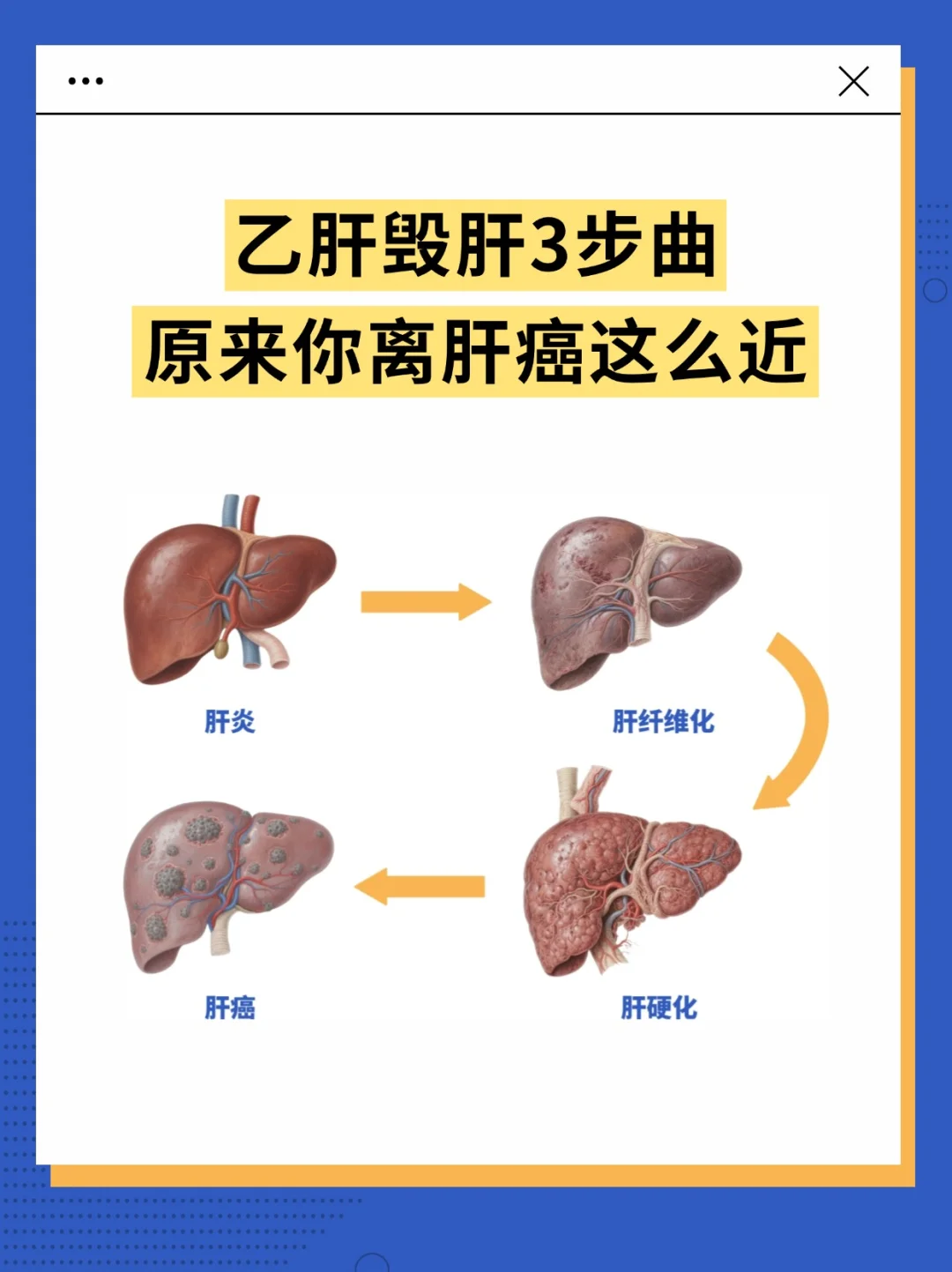 乙肝毁肝3步曲，原来你离肝癌这么近