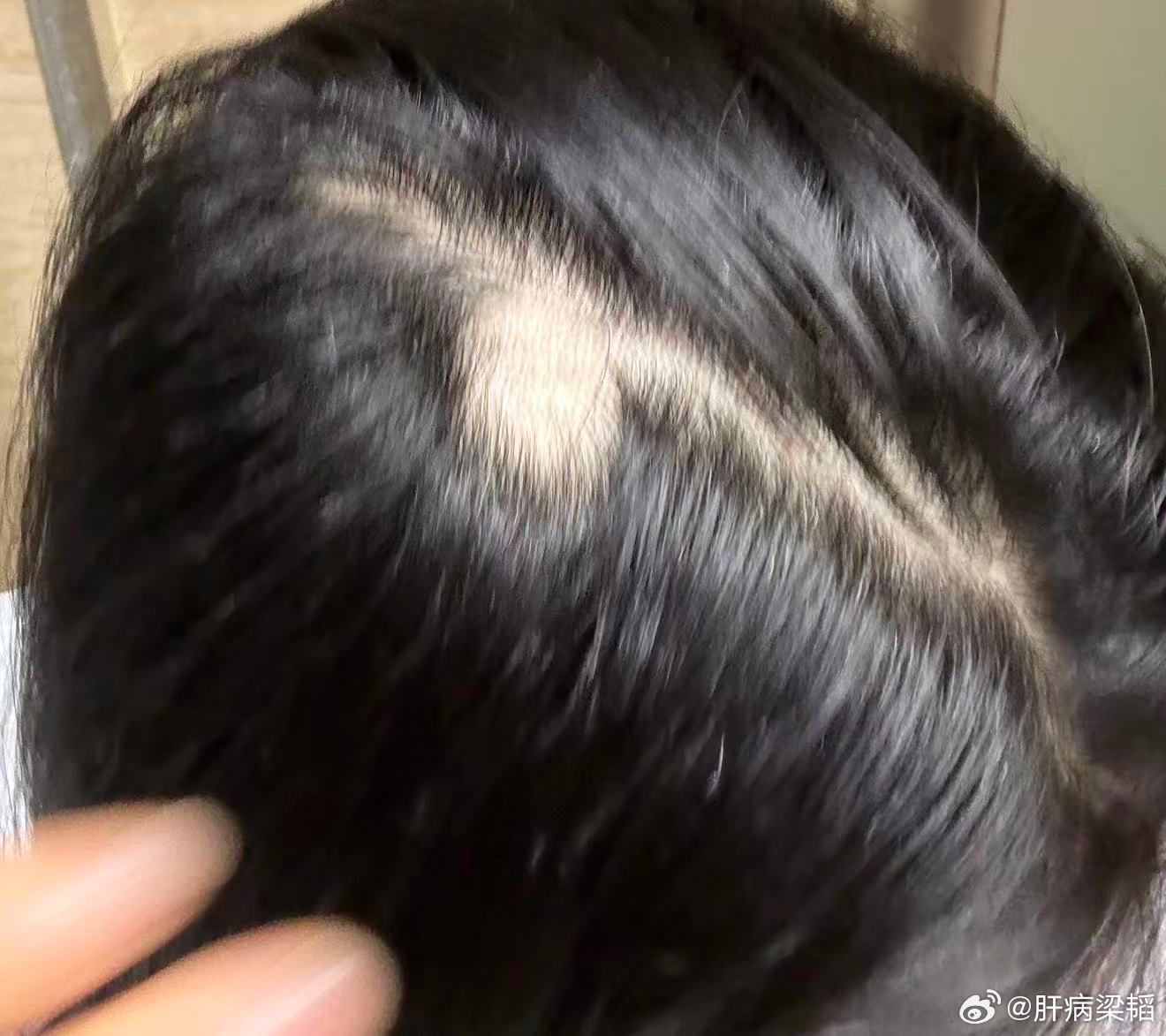 斑秃是一种突然发生的局限性斑片状脱发性毛发病，典型表现为头皮出现圆形或椭圆形、边