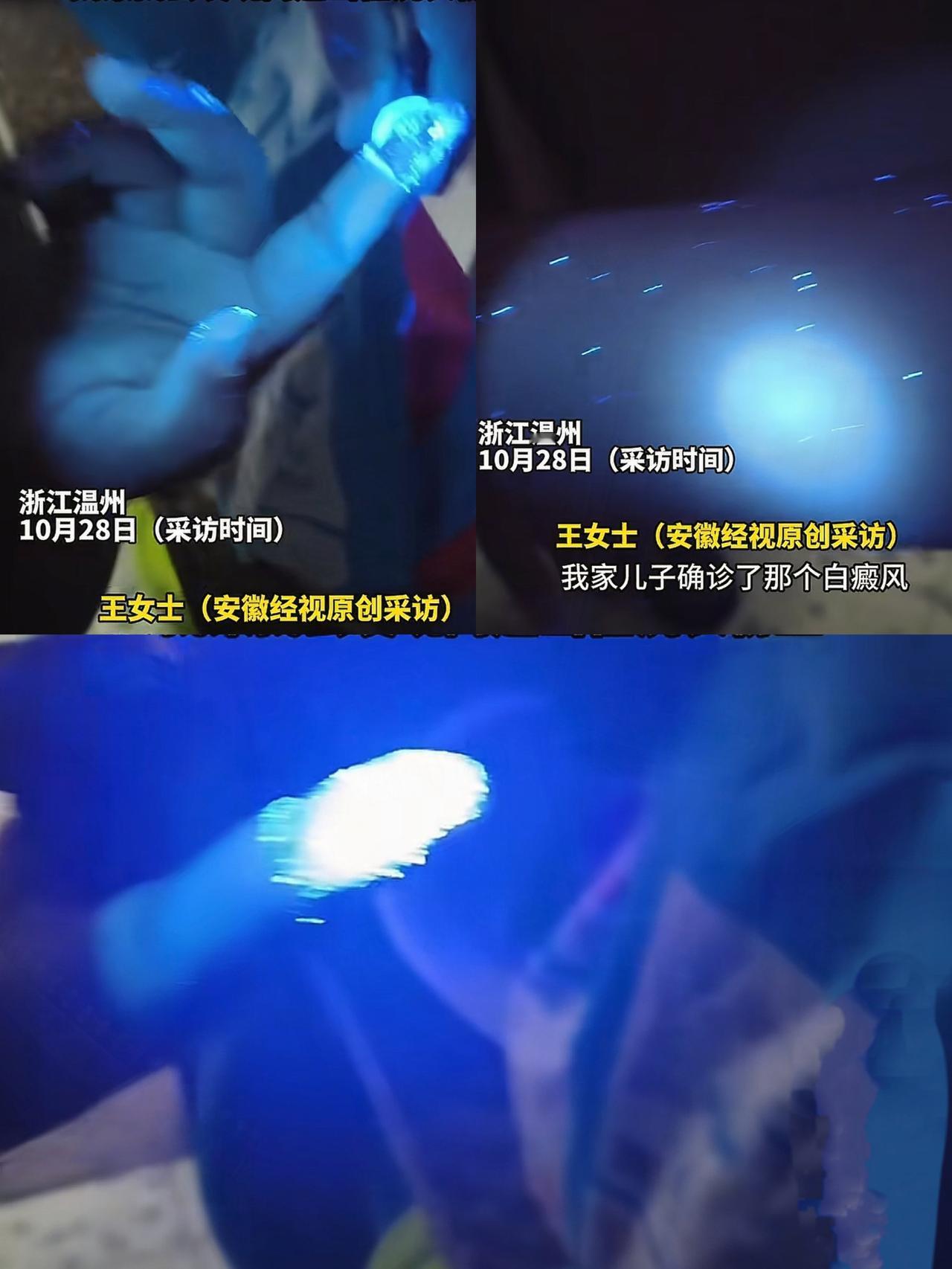 “彻底解释不清了!”浙江温州,王女士的儿子确诊了白癜风,医院开了紫光灯,回家一